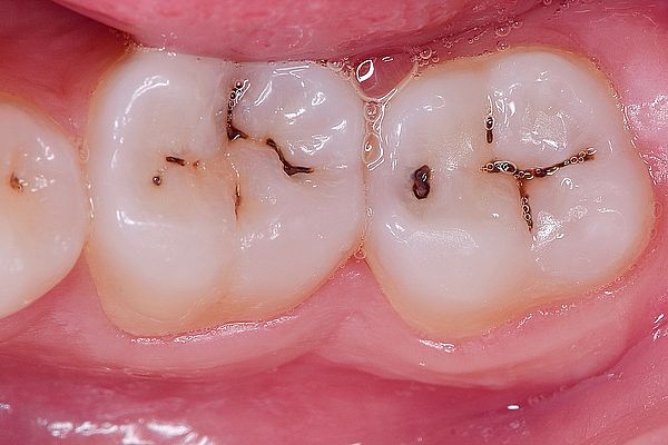 ¿Por qué algunas lesiones de caries se vuelven negras?