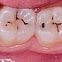 ¿Por qué algunas lesiones de caries se vuelven negras?