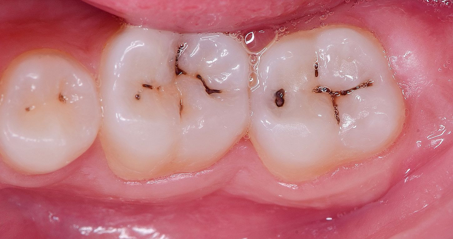 ¿Por qué algunas lesiones de caries se vuelven negras?