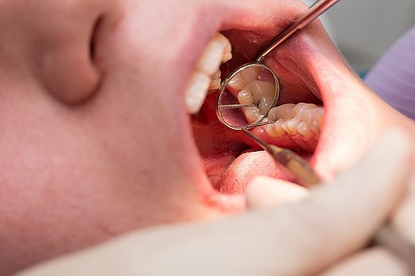 ICDAS: la nueva forma de diagnosticar la caries antes de que aparezca un agujero