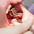 ICDAS: la nueva forma de diagnosticar la caries antes de que aparezca un agujero