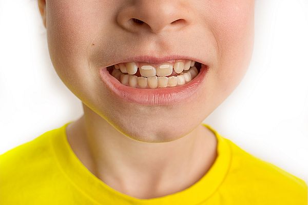 Manchas blancas en los dientes de tu hijo: la primera señal de alarma