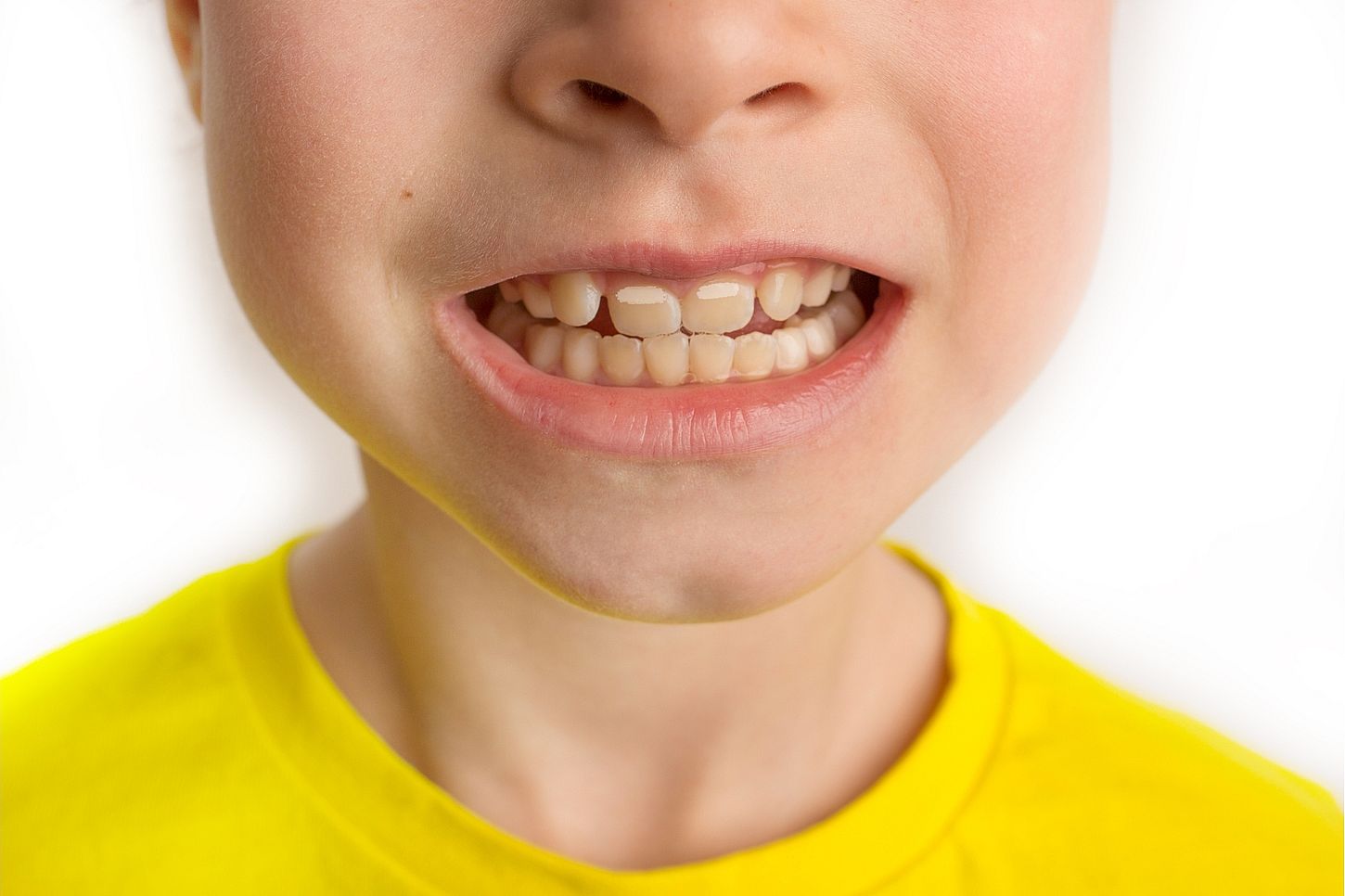 Manchas blancas en los dientes de tu hijo: la primera señal de alarma