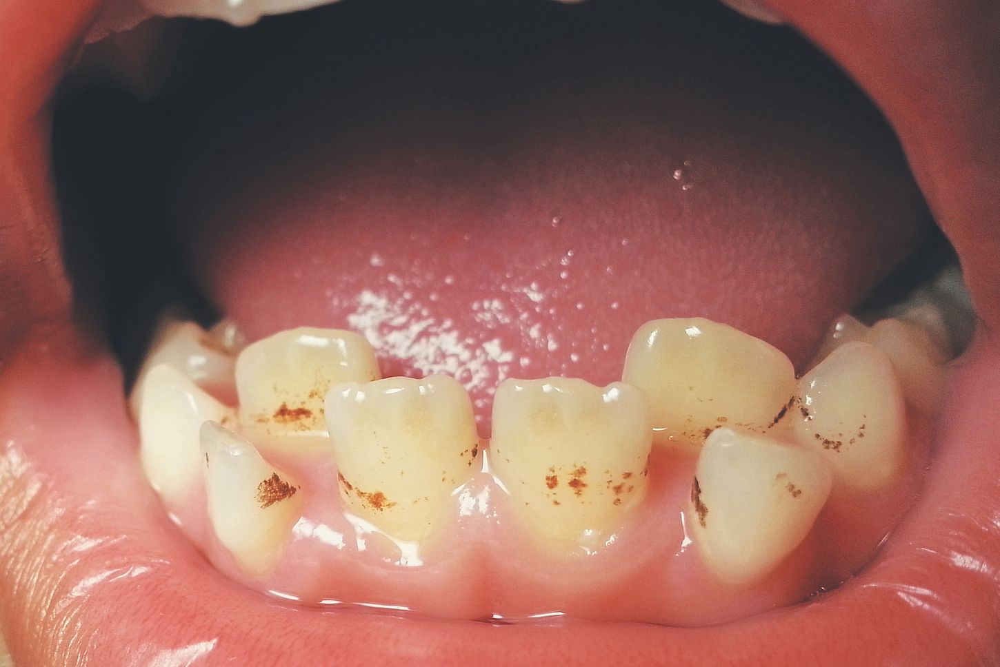 Manchas cromógenas negras en niños: una mirada al microbioma oral