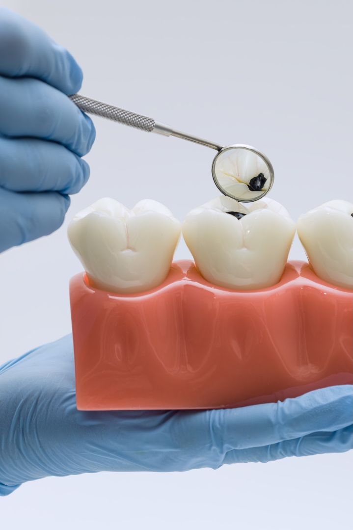 Caries clinica dental ourense