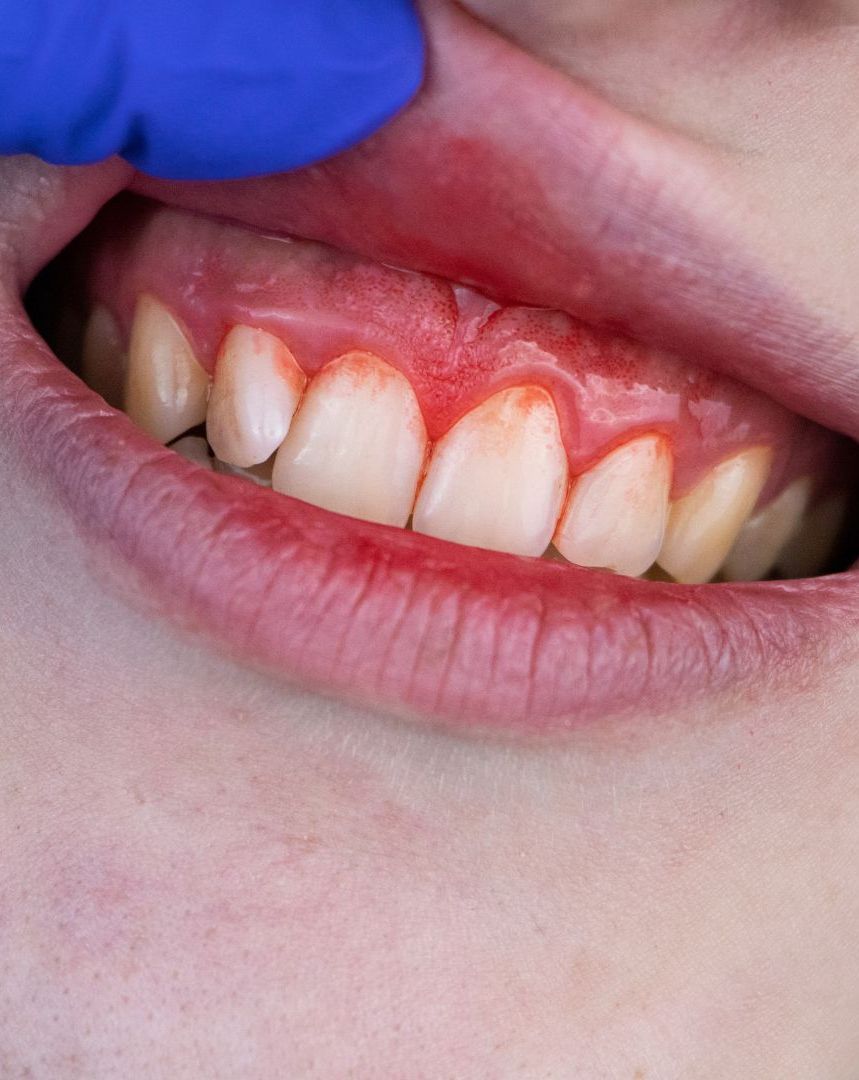Enfermedad Periodontal clinica dental ourense